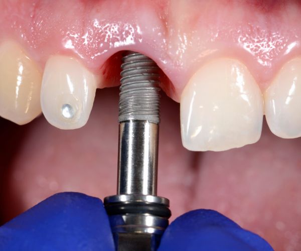 Implantes dentales en Roldán Santa Fe