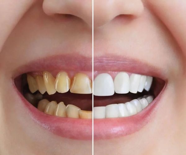 Estética dental en Roldán